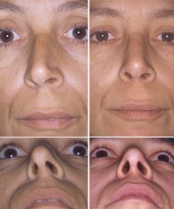 découvrez tout sur la chirurgie du septum dévié : une intervention visant à corriger une déviation du septum nasal, pour améliorer la respiration et réduire les problèmes de sinus. informez-vous sur les procédures, les bénéfices, et les conseils post-opératoires.