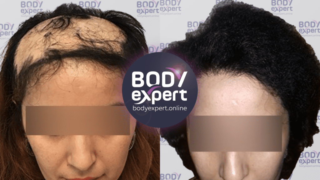 obtenez votre devis gratuit pour un implant capillaire. découvrez les options disponibles, les tarifs et les étapes de la procédure pour retrouver une chevelure dense et naturelle. transformez votre regard dès maintenant !