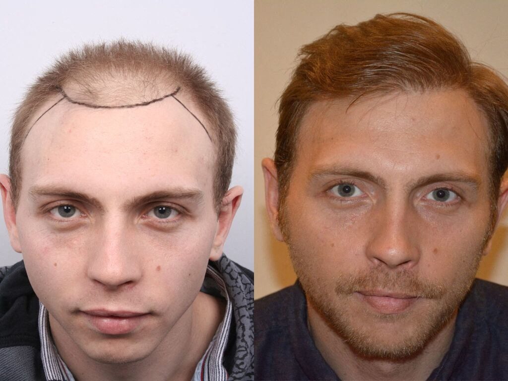 obtenez votre devis gratuit pour une greffe de cheveux et découvrez les solutions adaptées à votre besoin. profitez d'une consultation personnalisée et des conseils d'experts pour retrouver votre confiance en vous.