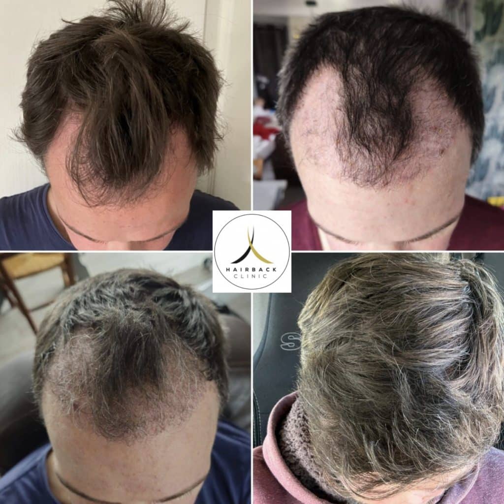 obtenez votre devis gratuit pour une greffe de cheveux et découvrez les solutions adaptées à vos besoins capillaires. en seulement quelques étapes, évaluez les options qui s'offrent à vous pour retrouver une chevelure dense et naturelle.