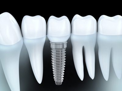 obtenez votre devis gratuit pour un implant dentaire en quelques étapes simples. bénéficiez d'une consultation personnalisée et découvrez les options qui s'offrent à vous pour retrouver le sourire en toute confiance.