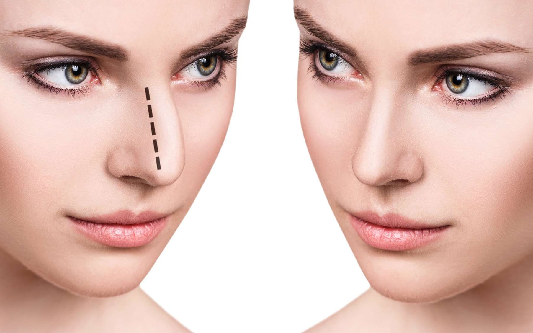 obtenez votre devis gratuit pour une rhinoplastie et découvrez les options qui s'offrent à vous. transformez votre apparence en toute confiance grâce à nos experts en chirurgie esthétique.