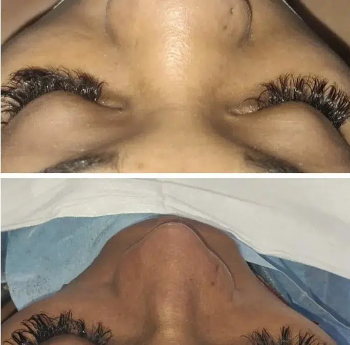 obtenez votre devis gratuit pour une rhinoplastie et découvrez les options qui s'offrent à vous. profitez d'une consultation personnalisée pour évaluer vos besoins et envisager une transformation esthétique en toute sérénité.